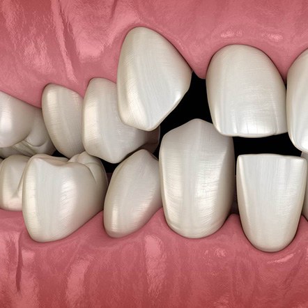 Illustration of spaced out teeth