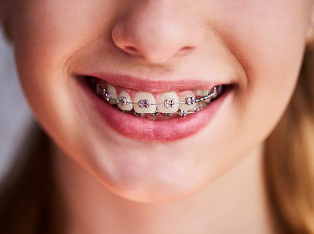 Close up of braces