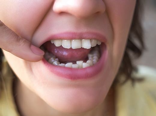 Picture of crowded teeth