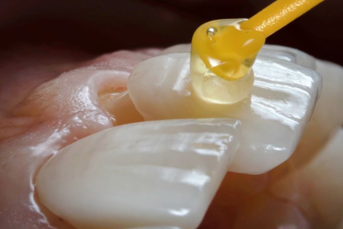 A veneer being attached to a tooth.